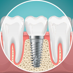 DoYouHaveAdequateBonetoSupportanImplant