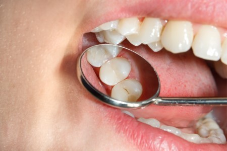 A Quick, Painless Way of Sealing Out Tooth Decay
